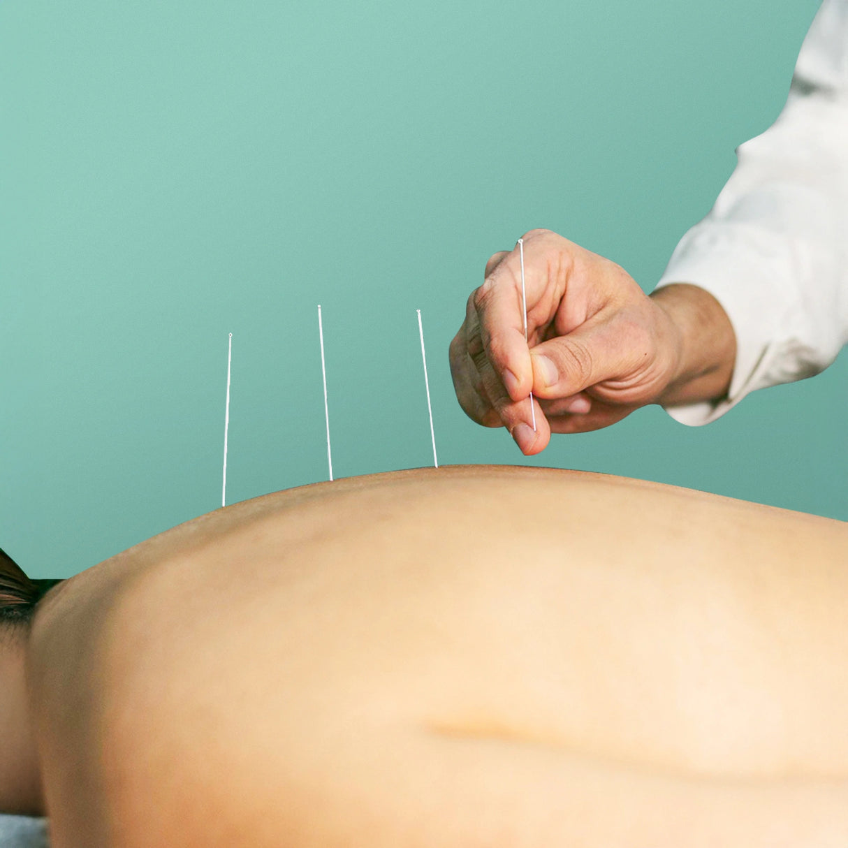 Dry Needling (Trigger-Point) Session